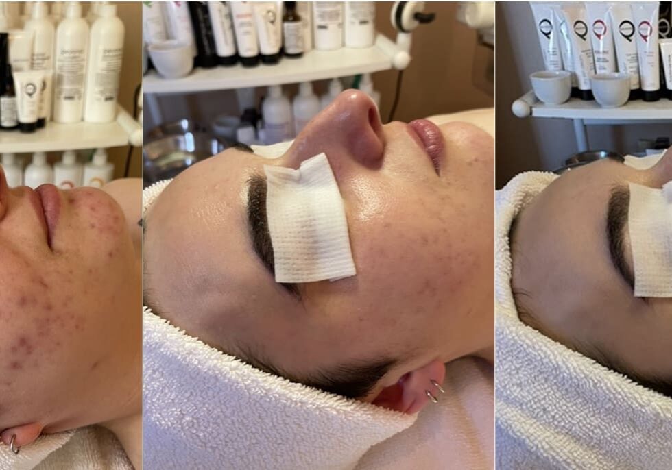 Progression of acne healing results at John Francis Spa